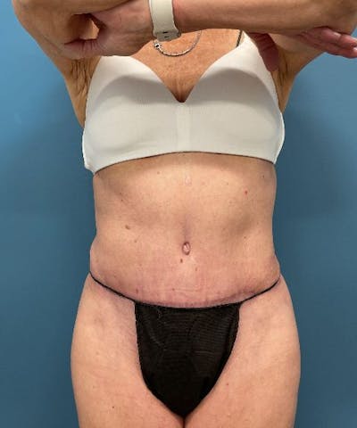 Powertuck Before & After Gallery - Patient 226073 - Image 1