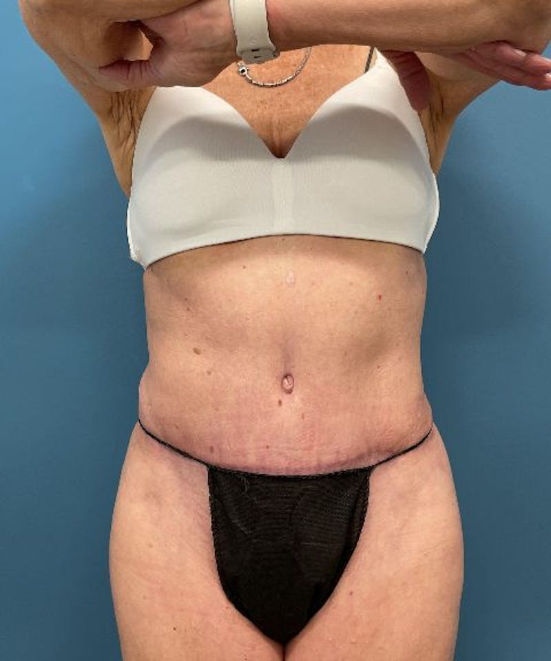 Powertuck Before & After Gallery - Patient 226073 - Image 1