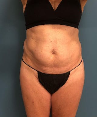 Powertuck Before & After Gallery - Patient 226073 - Image 2