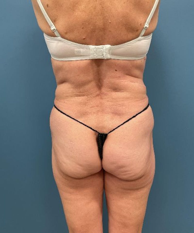 Powertuck Before & After Gallery - Patient 226073 - Image 3