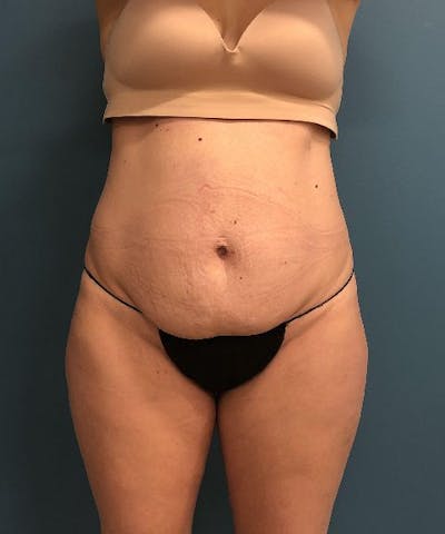Powertuck Before & After Gallery - Patient 112601 - Image 1