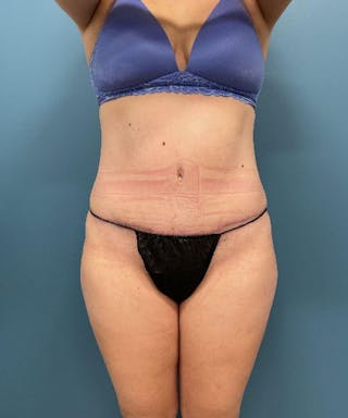 Powertuck Before & After Gallery - Patient 112601 - Image 2