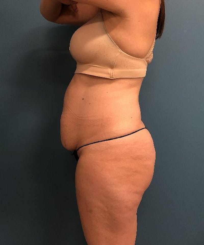 Powertuck Before & After Gallery - Patient 112601 - Image 3