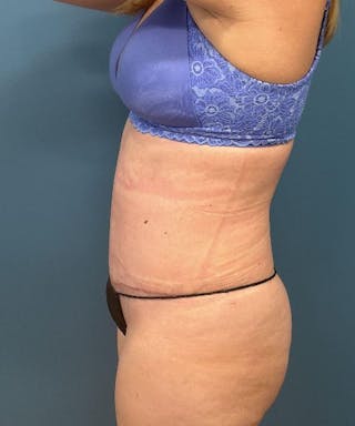 Powertuck Before & After Gallery - Patient 112601 - Image 4