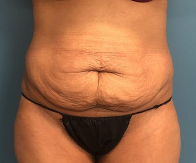 Powertuck Before & After Gallery - Patient 127132 - Image 1