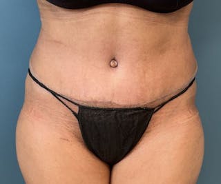 Powertuck Before & After Gallery - Patient 127132 - Image 2