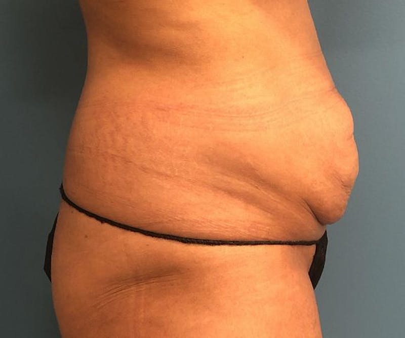 Powertuck Before & After Gallery - Patient 127132 - Image 3