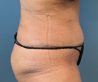 Powertuck Before & After Gallery - Patient 127132 - Image 4