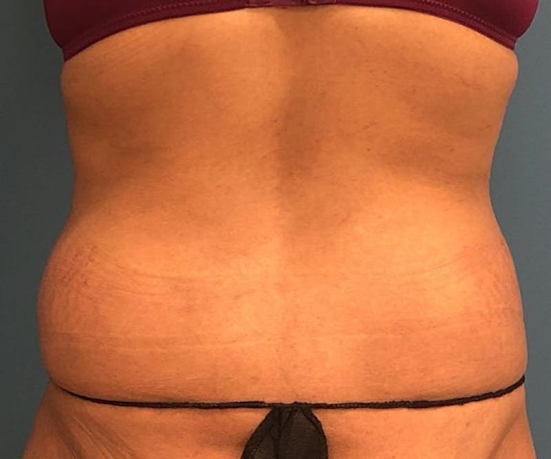 Powertuck Before & After Gallery - Patient 127132 - Image 5