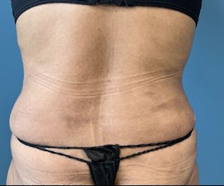 Powertuck Before & After Gallery - Patient 127132 - Image 6