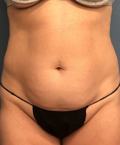 Powertuck Before & After Gallery - Patient 741033 - Image 1