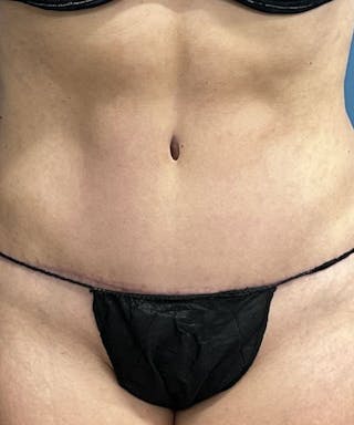 Powertuck Before & After Gallery - Patient 741033 - Image 2