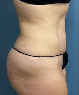 Powertuck Before & After Gallery - Patient 741033 - Image 4