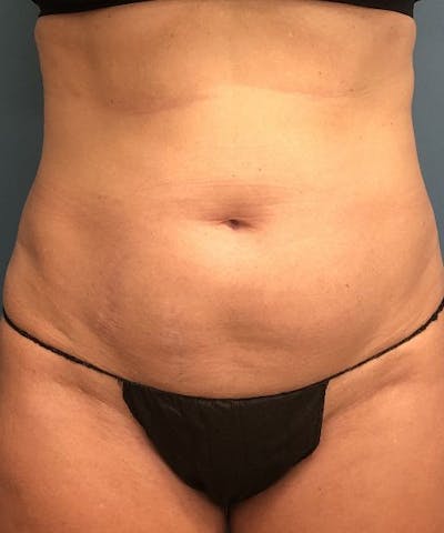 Powertuck Before & After Gallery - Patient 301979 - Image 1