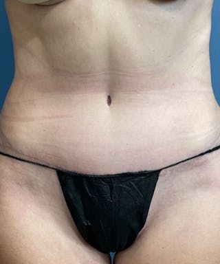 Powertuck Before & After Gallery - Patient 301979 - Image 2