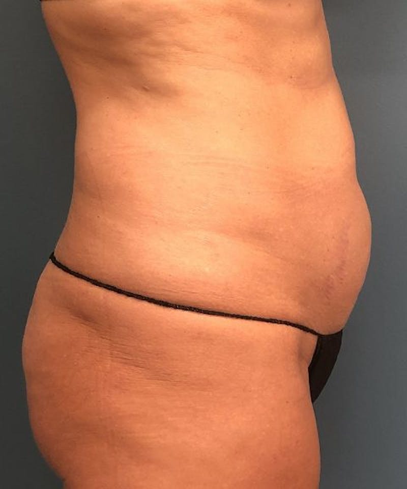 Powertuck Before & After Gallery - Patient 301979 - Image 3