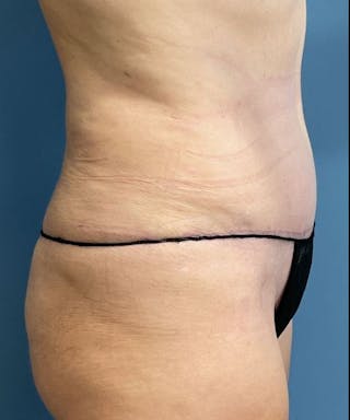 Powertuck Before & After Gallery - Patient 301979 - Image 4