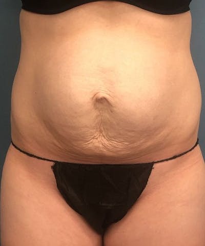 Powertuck Before & After Gallery - Patient 164322 - Image 1