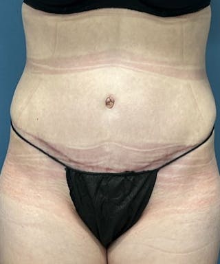 Powertuck Before & After Gallery - Patient 164322 - Image 2
