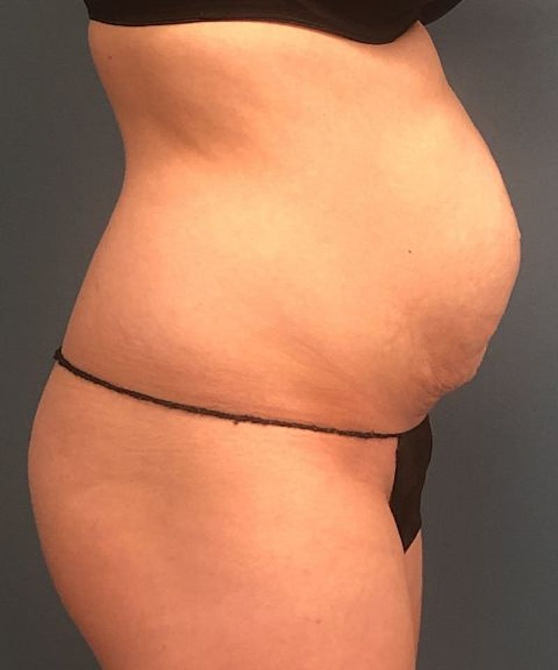 Powertuck Before & After Gallery - Patient 164322 - Image 3