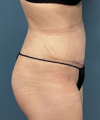 Powertuck Before & After Gallery - Patient 164322 - Image 4