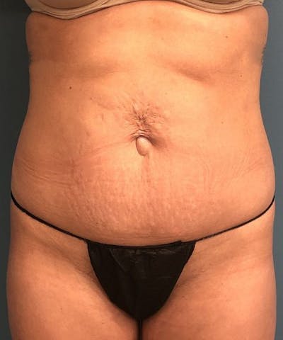 Powertuck Before & After Gallery - Patient 694188 - Image 1