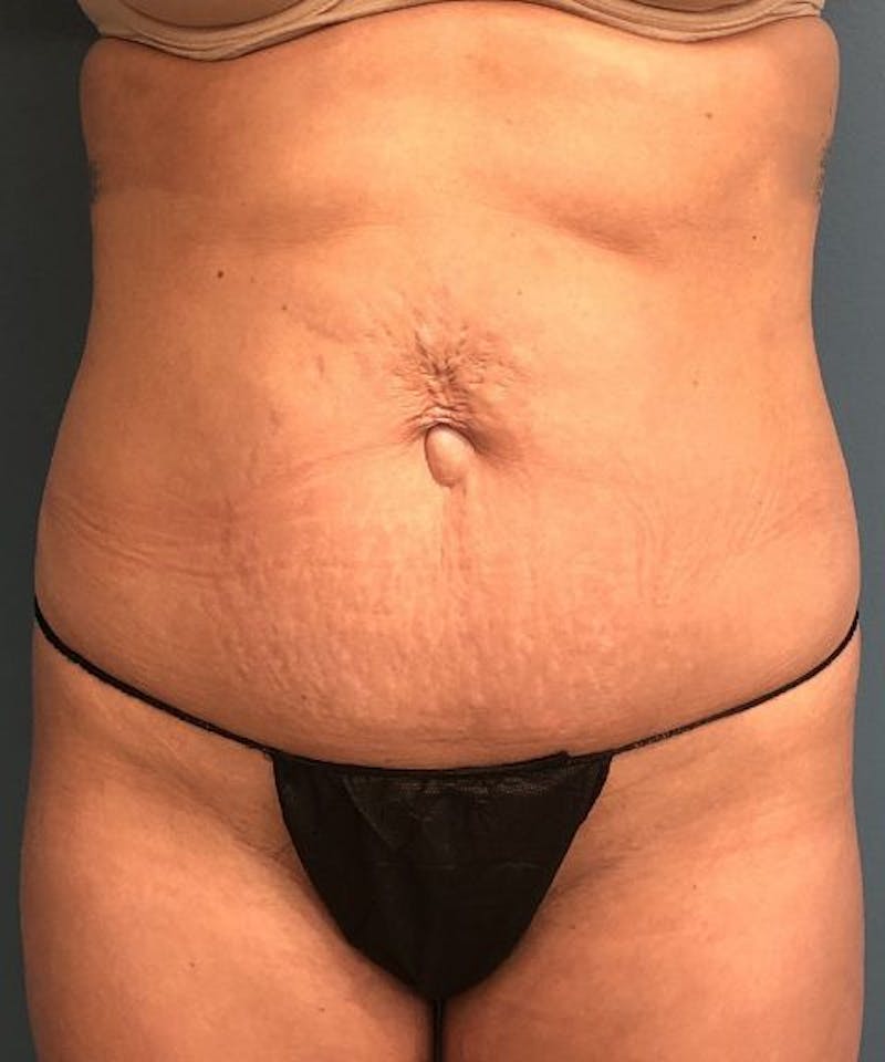 Powertuck Before & After Gallery - Patient 694188 - Image 1