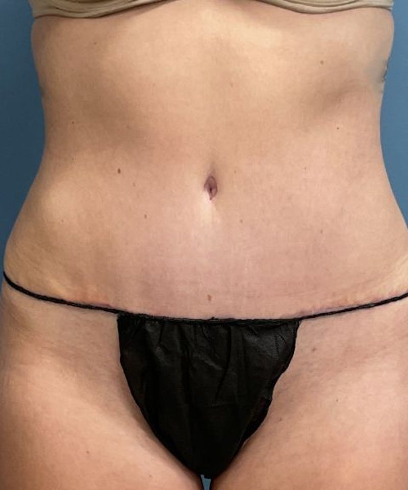 Powertuck Before & After Gallery - Patient 694188 - Image 2