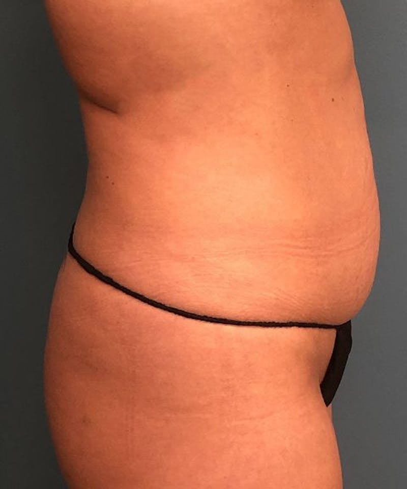 Powertuck Before & After Gallery - Patient 694188 - Image 3