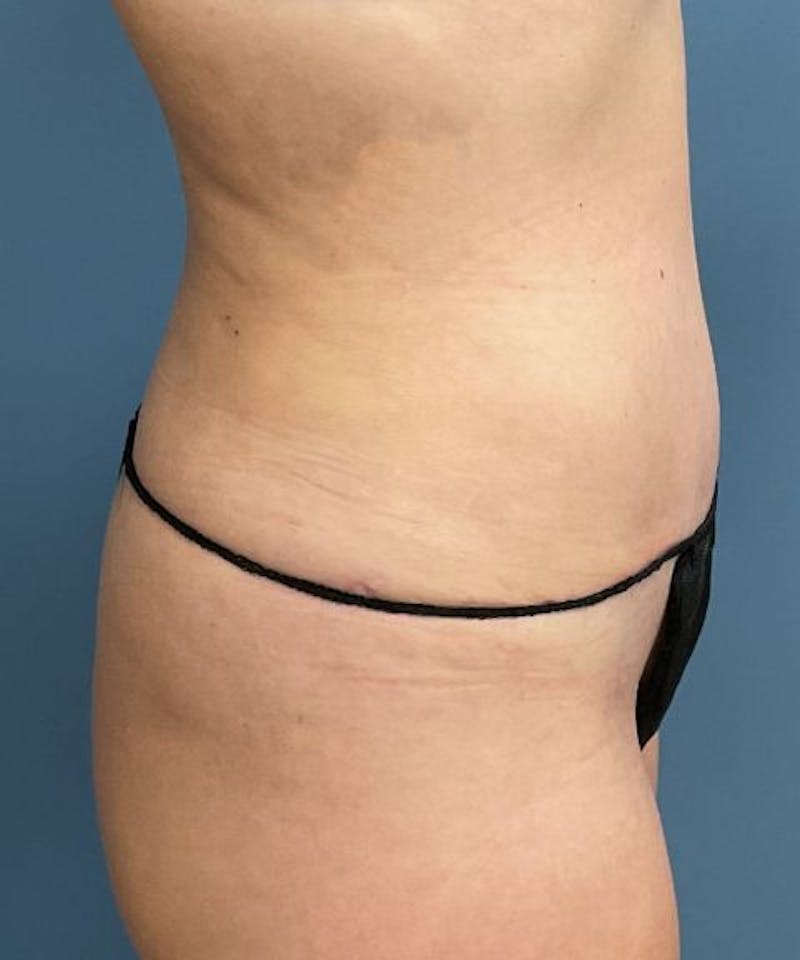 Powertuck Before & After Gallery - Patient 694188 - Image 4