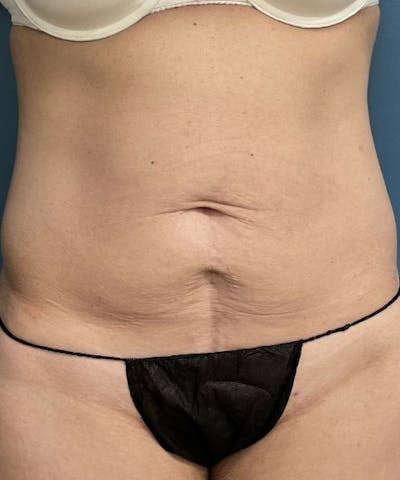 Tummy Tuck Before & After Gallery - Patient 409083 - Image 1