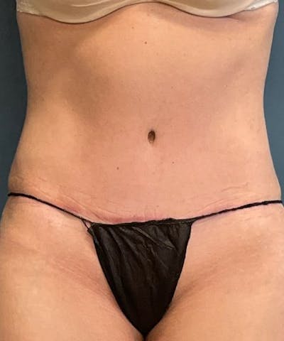 Tummy Tuck Before & After Gallery - Patient 409083 - Image 2
