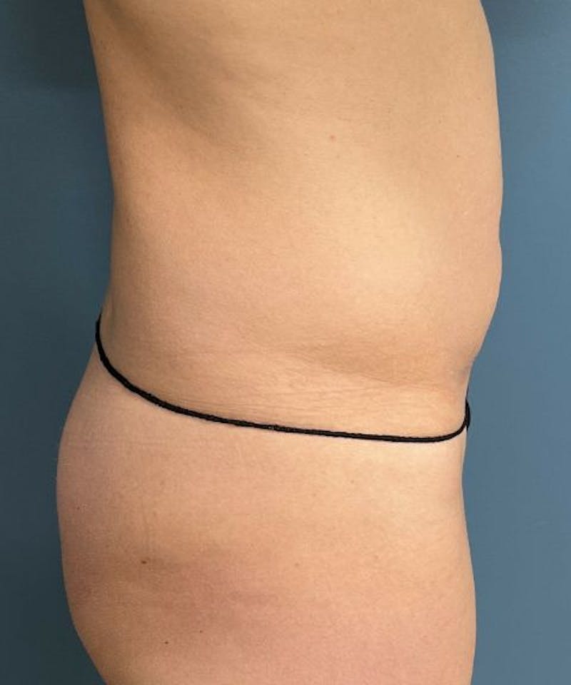 Tummy Tuck Before & After Gallery - Patient 409083 - Image 3
