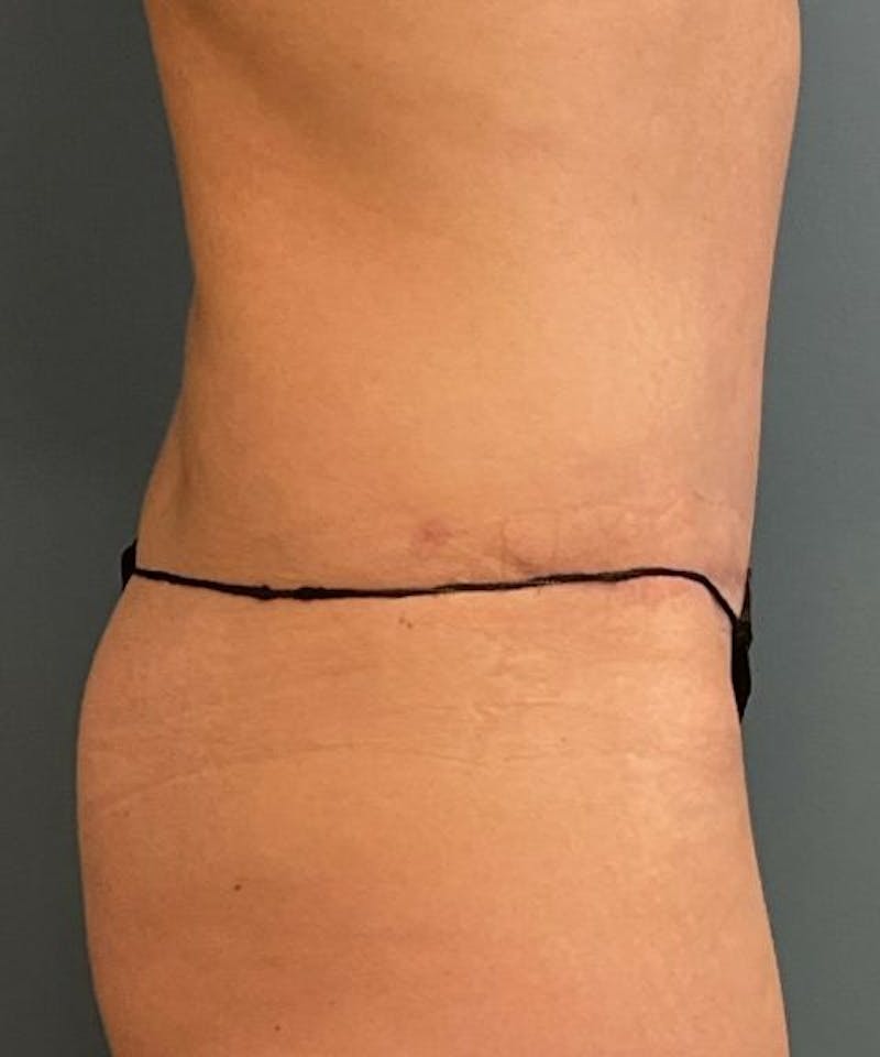 Tummy Tuck Before & After Gallery - Patient 409083 - Image 4