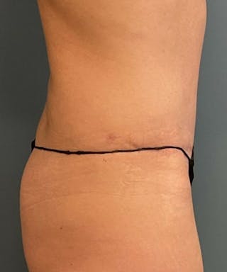 Tummy Tuck Before & After Gallery - Patient 409083 - Image 4