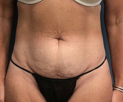 Tummy Tuck Before & After Gallery - Patient 254129 - Image 1