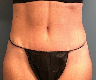 Tummy Tuck Before & After Gallery - Patient 254129 - Image 2