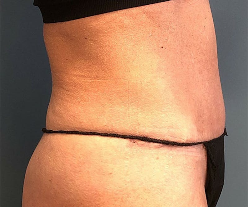 Tummy Tuck Before & After Gallery - Patient 254129 - Image 3