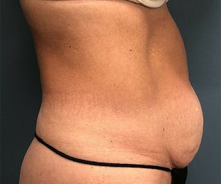 Tummy Tuck Before & After Gallery - Patient 254129 - Image 4