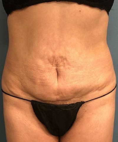 Tummy Tuck Before & After Gallery - Patient 252843 - Image 1