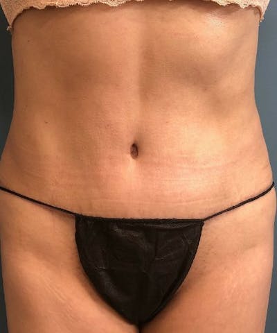 Tummy Tuck Before & After Gallery - Patient 252843 - Image 2