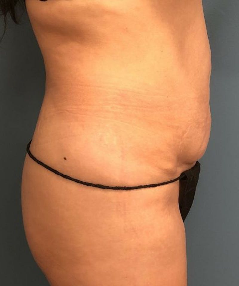 Tummy Tuck Before & After Gallery - Patient 252843 - Image 3