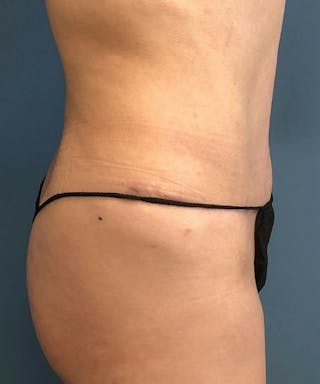 Tummy Tuck Before & After Gallery - Patient 252843 - Image 4