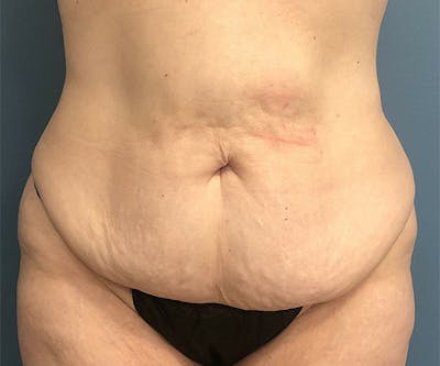 Tummy Tuck Before & After Gallery - Patient 318570 - Image 1