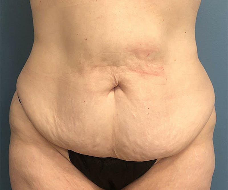 Tummy Tuck Before & After Gallery - Patient 318570 - Image 1