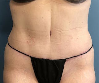 Tummy Tuck Before & After Gallery - Patient 318570 - Image 2
