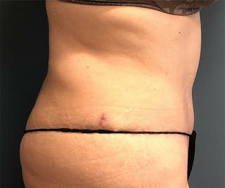 Tummy Tuck Before & After Gallery - Patient 318570 - Image 4