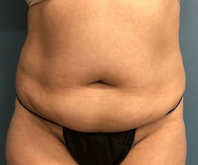 Tummy Tuck Before & After Gallery - Patient 246561 - Image 1