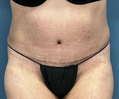 Tummy Tuck Before & After Gallery - Patient 246561 - Image 2