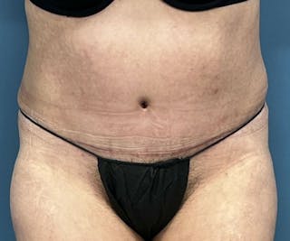 Tummy Tuck Before & After Gallery - Patient 246561 - Image 2